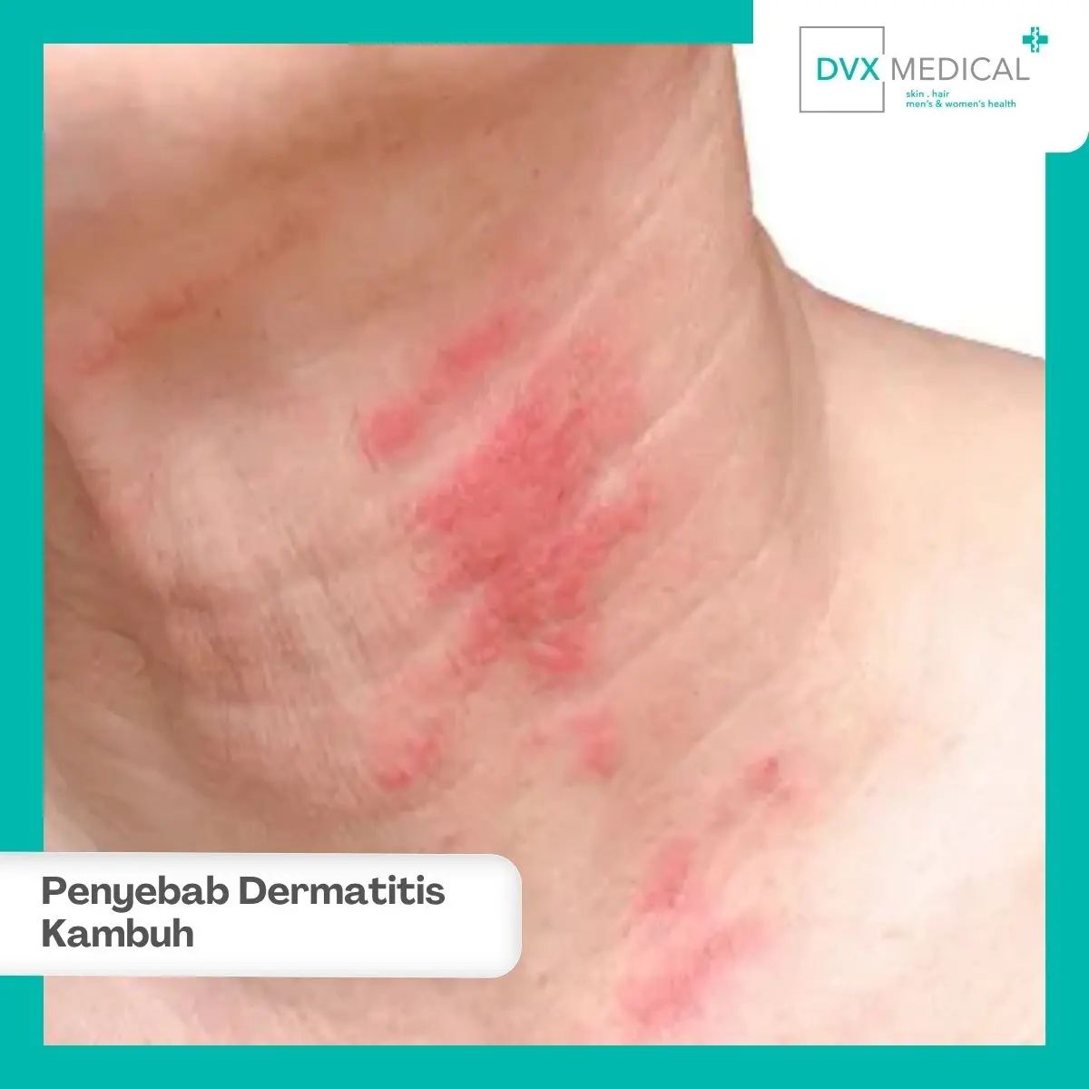 Mengapa Dermatitis Atopik Bisa Tetap Kambuh Meski Sudah Diobati?