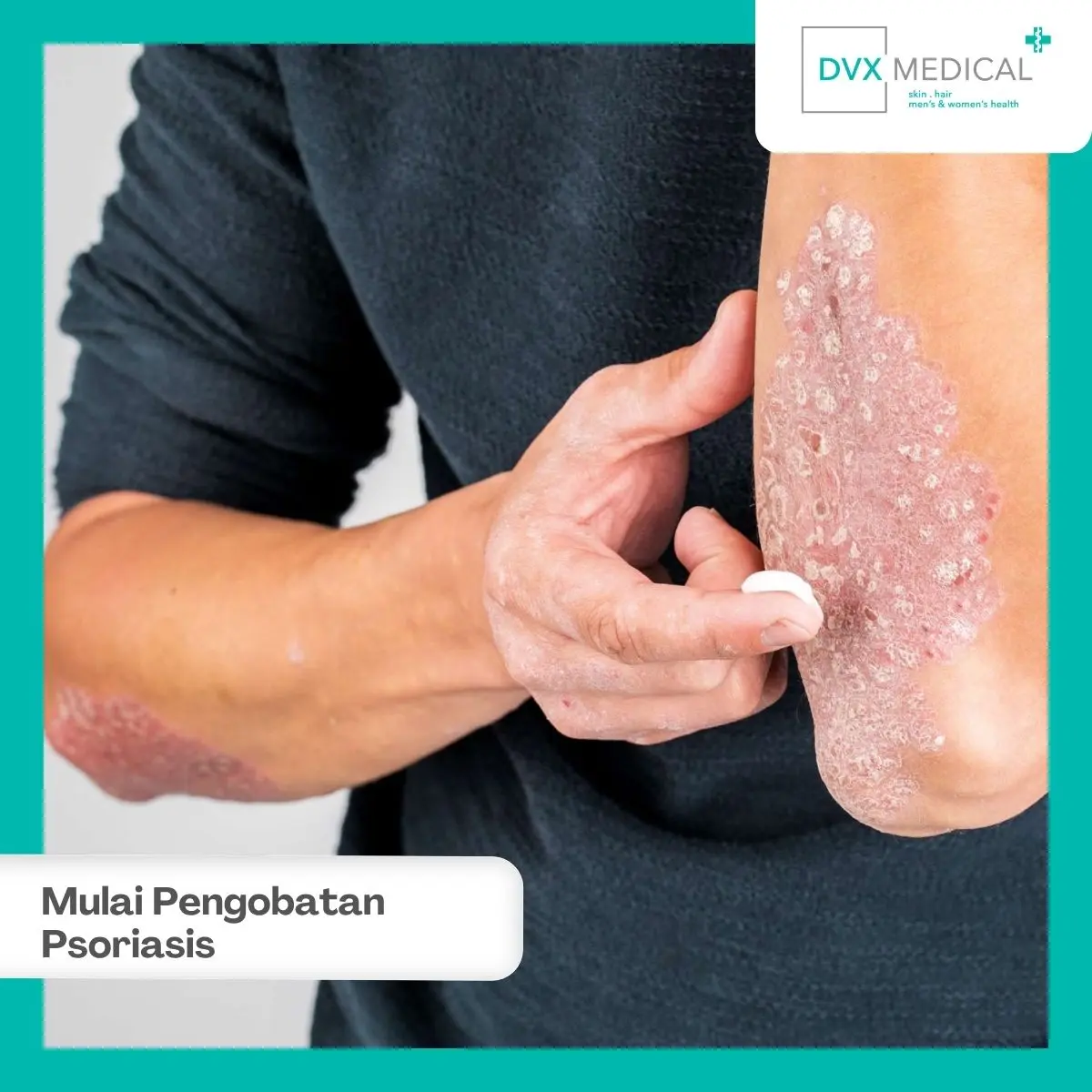 Bagaimana Cara Memulai Pengobatan Psoriasis di DVX Medical?