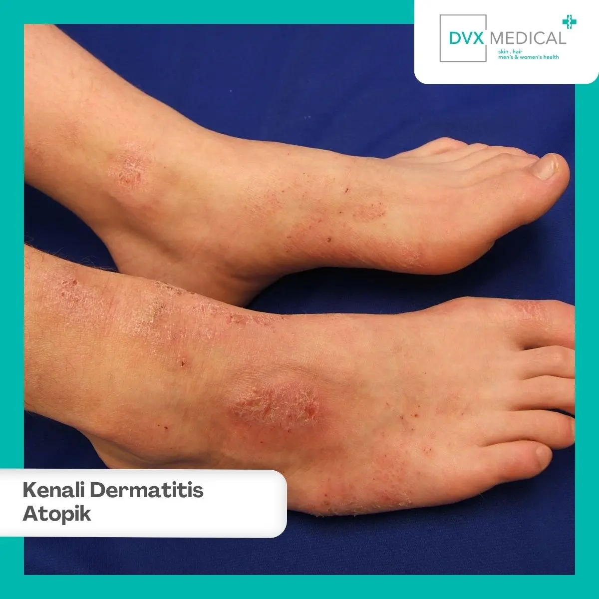 Apa Itu Dermatitis Atopik pada Orang Dewasa?