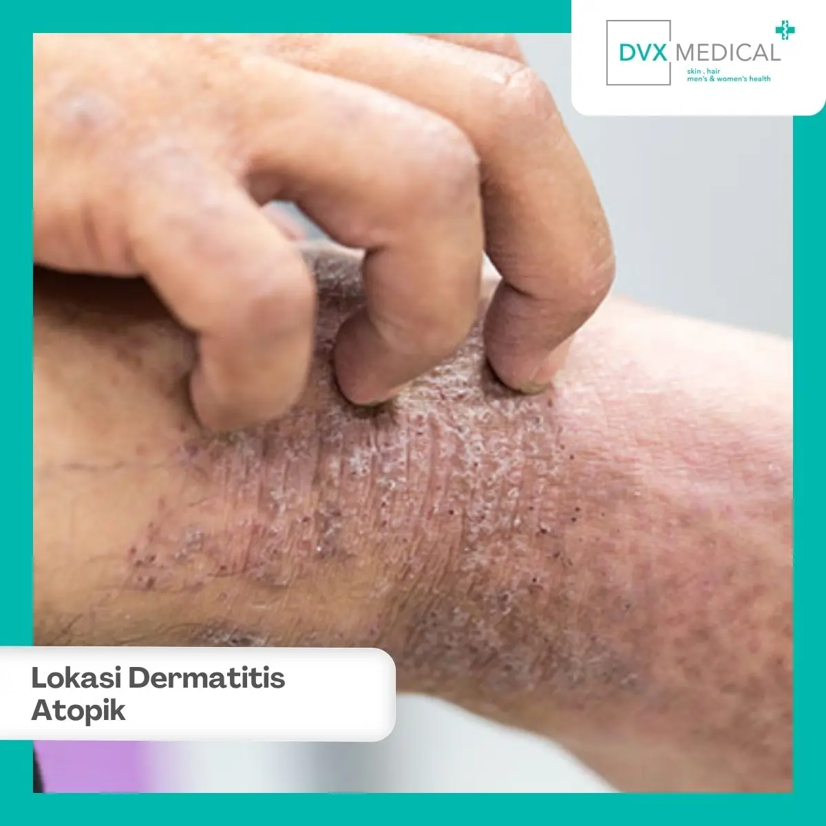 Bagian Tubuh Mana yang Sering Mengalami Dermatitis Atopik pada Dewasa?