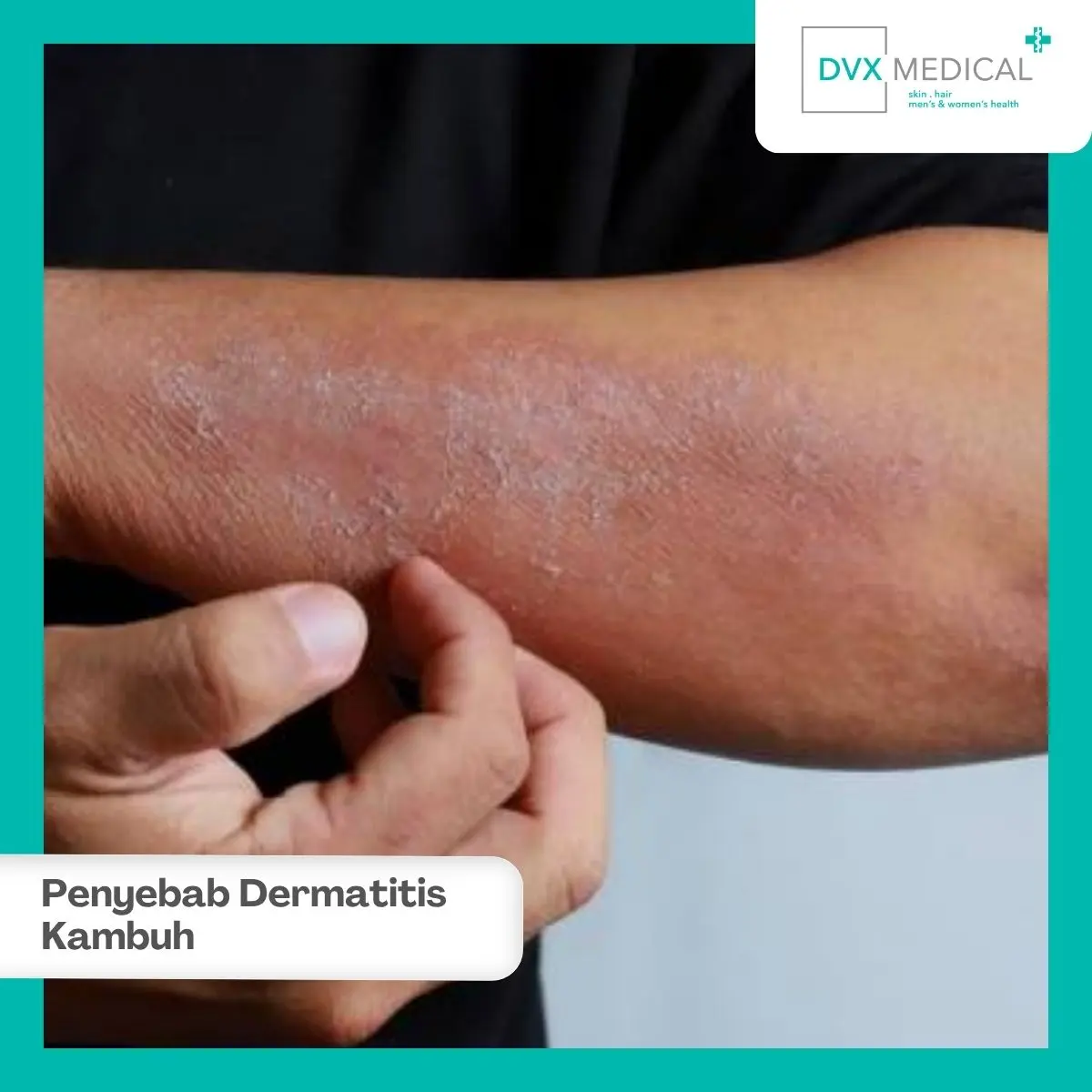 Mengapa Dermatitis Atopik Bisa Terus Kambuh?