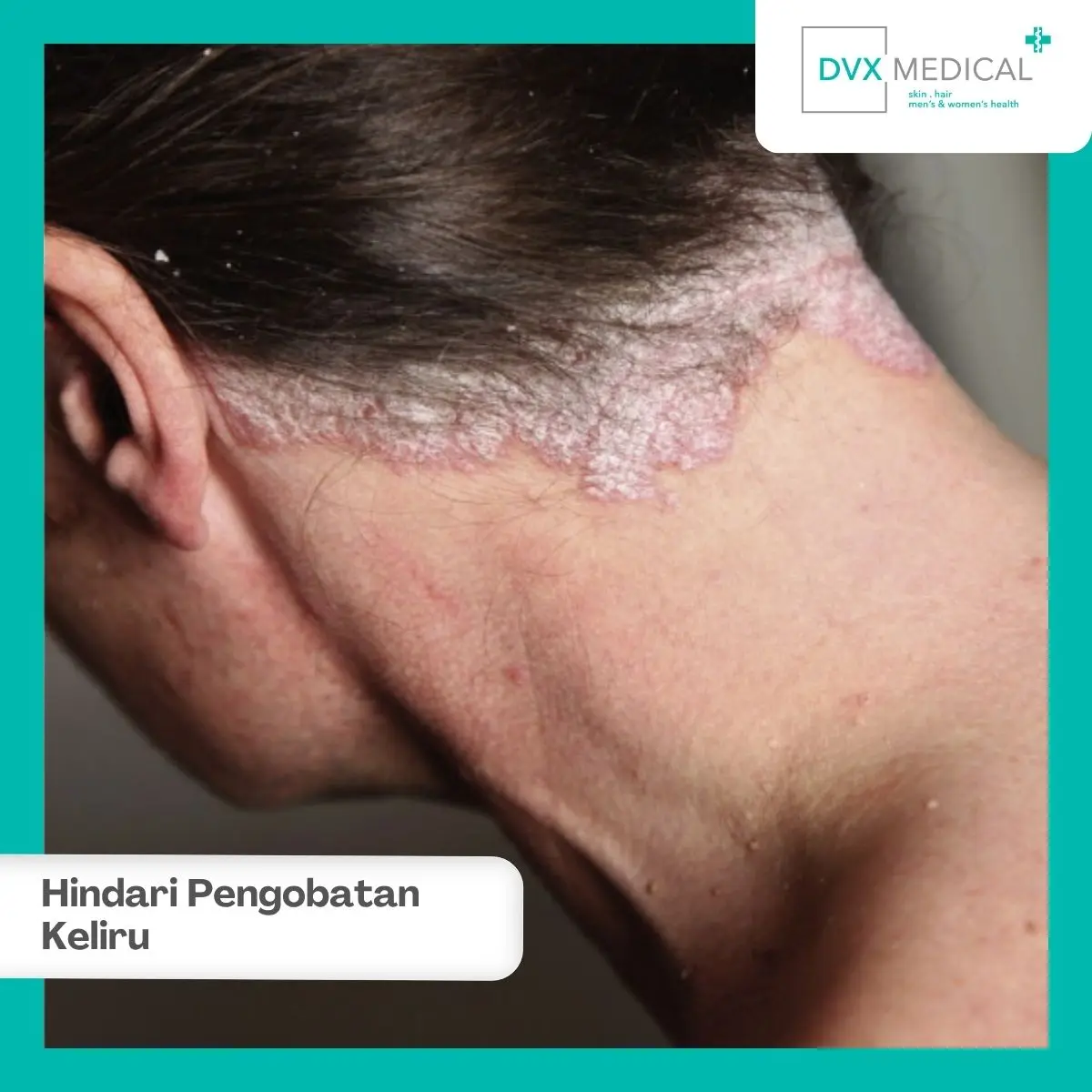 Bahaya Pengobatan Sendiri yang Keliru