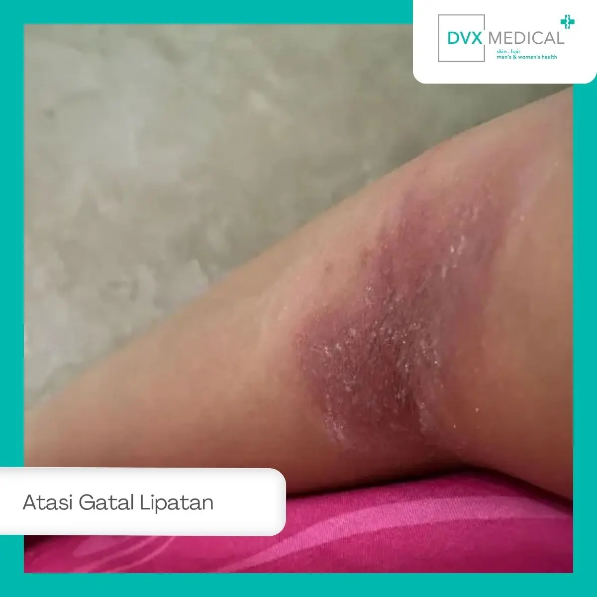 Sembuhkan Gatal di Lipatan Kulit di DVX Medical Jakarta