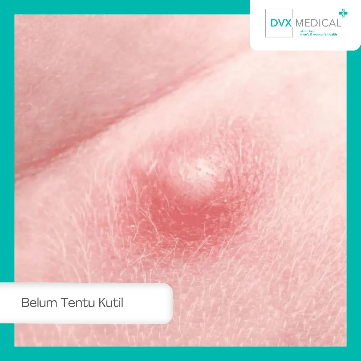 Apakah Benjolan di Area Genital Pasti Kutil Kelamin?