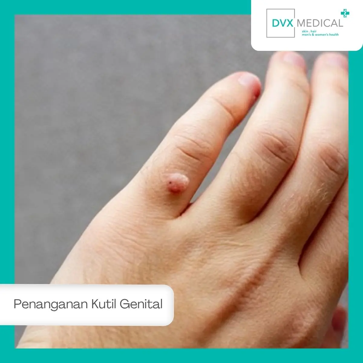 Penanganan Kutil di DVX Medical Jakarta