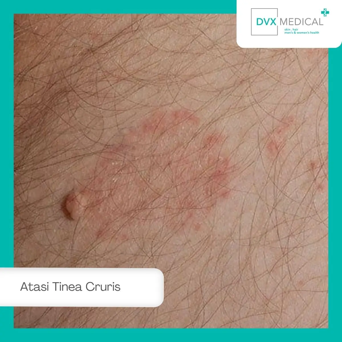 Penanganan Tinea Cruris di DVX Medical Jakarta