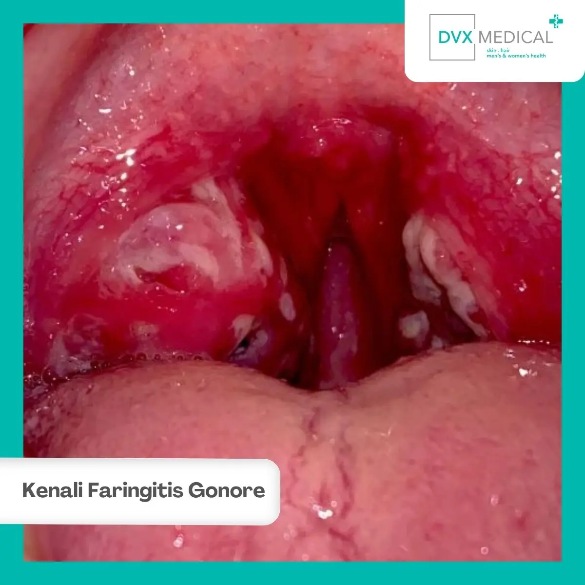 Cara Mencegah Faringitis Gonore