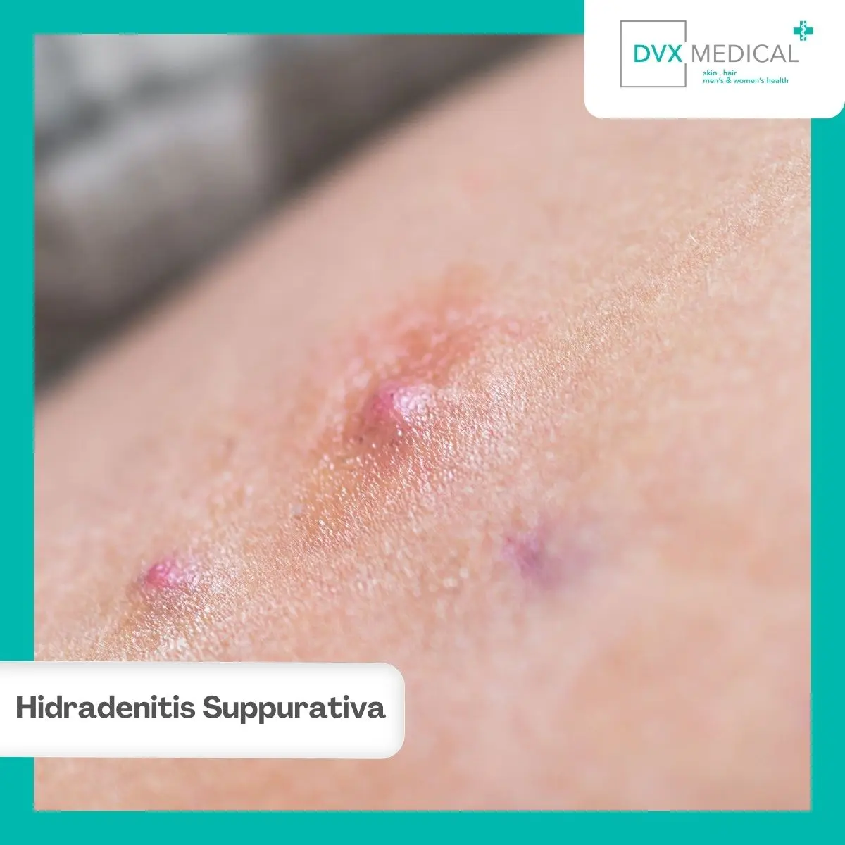Apa Itu Hidradenitis Suppurativa?