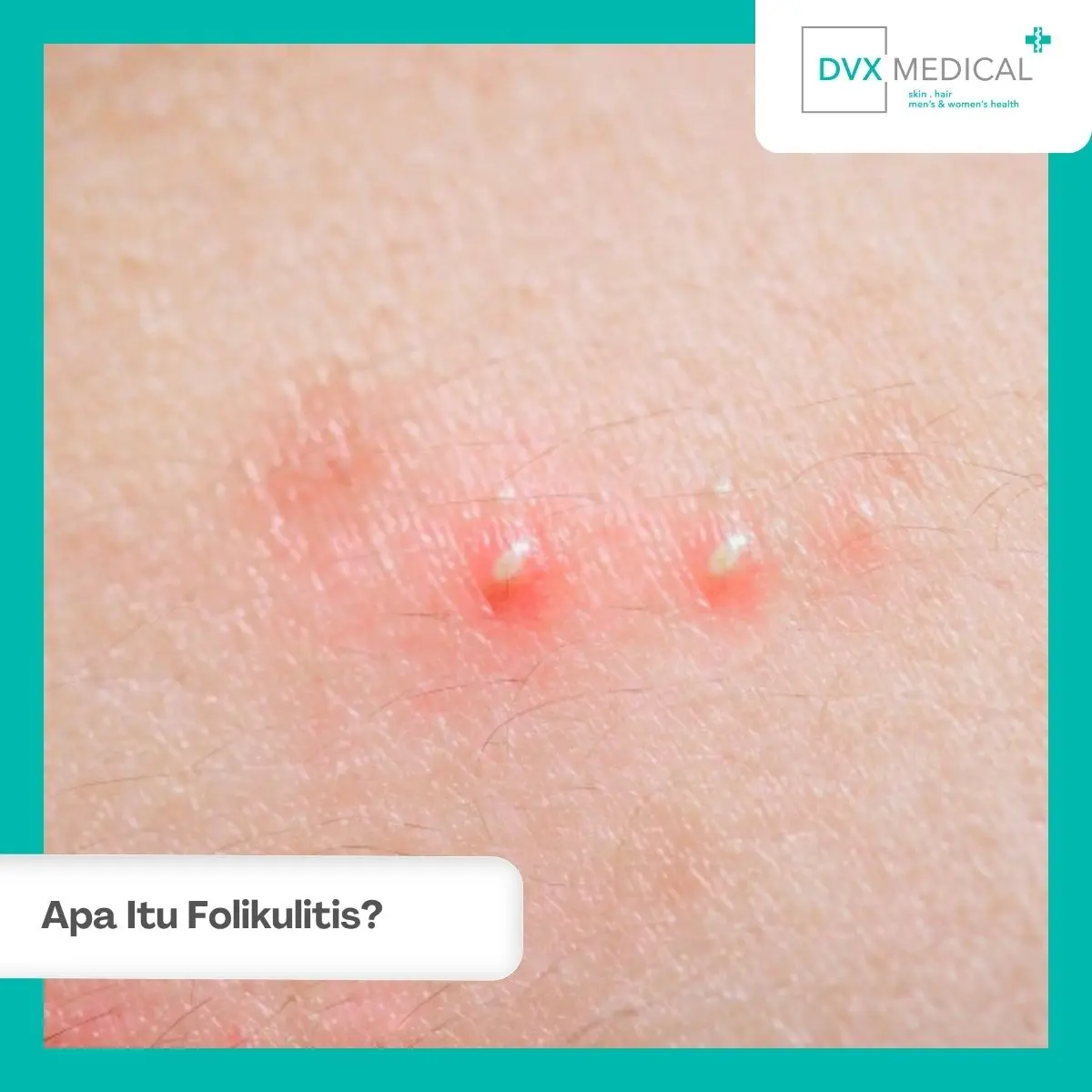 Apa Itu Folikulitis?