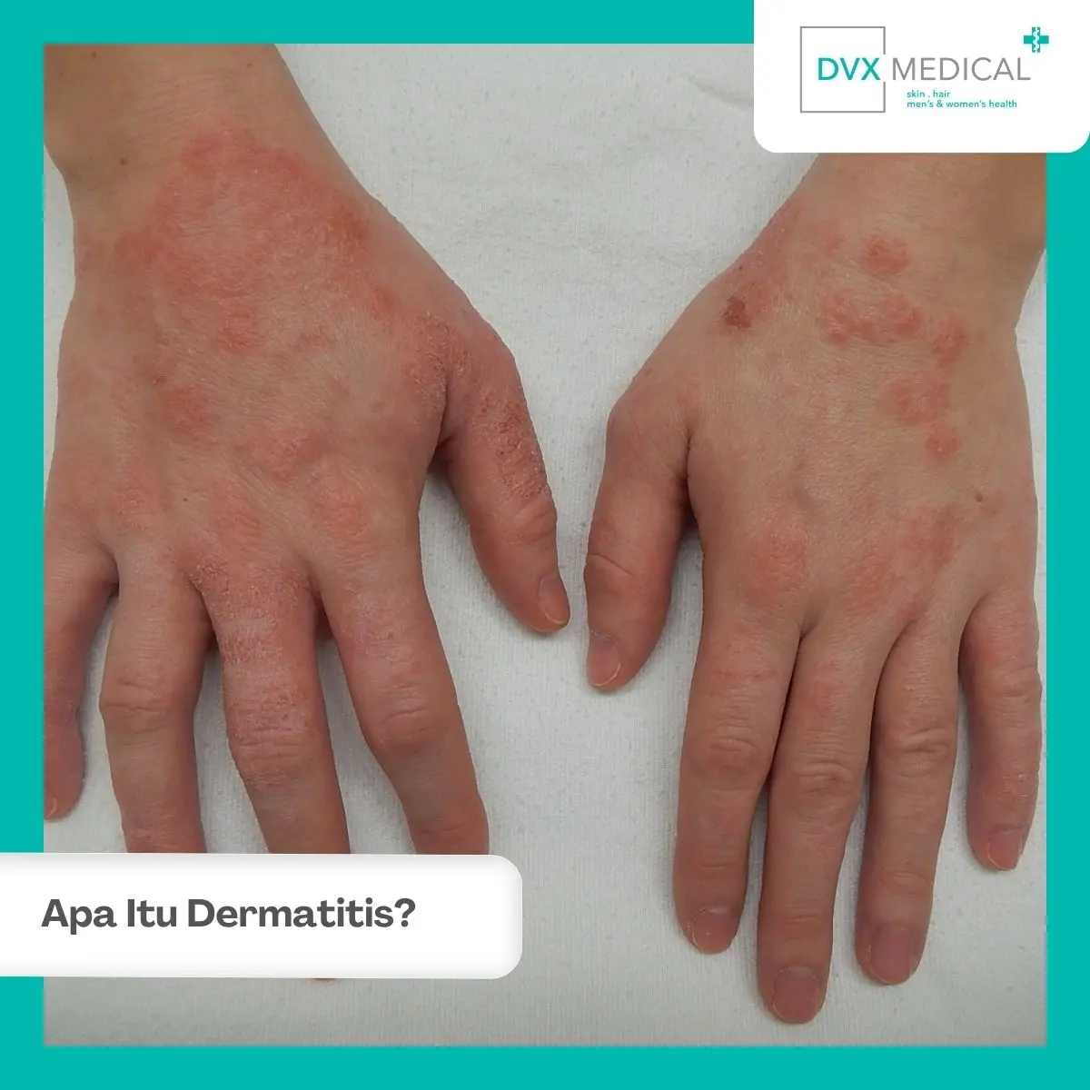 Apa Itu Dermatitis?