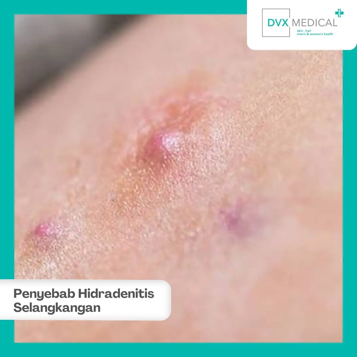 Mengapa Hidradenitis Suppurativa Sering Muncul di Selangkangan?