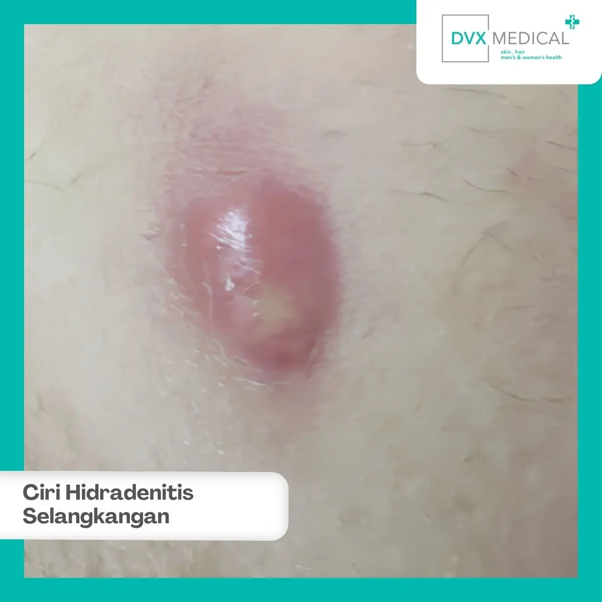 Seperti Apa Ciri Hidradenitis Suppurativa di Selangkangan?