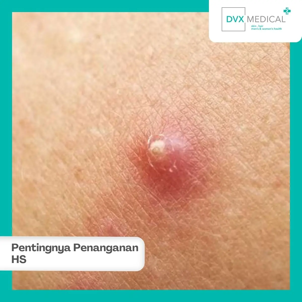 Mengapa Hidradenitis Suppurativa Perlu Ditangani dengan Tepat?