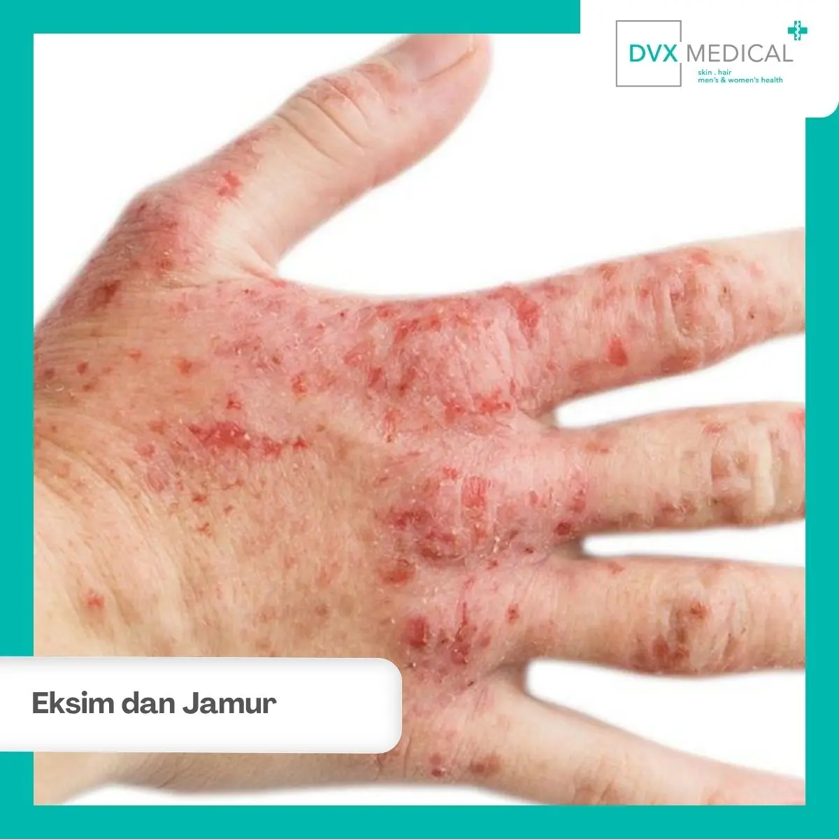 Mengapa Eksim dan Jamur Kulit Sering Tertukar?