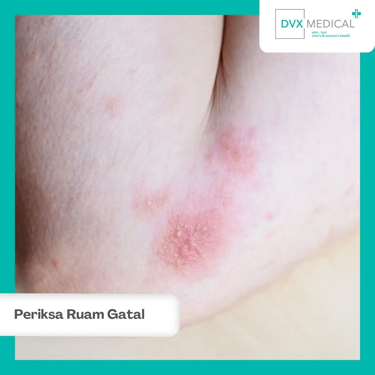 Kapan Ruam Gatal Perlu Dibawa ke Dokter Kulit?