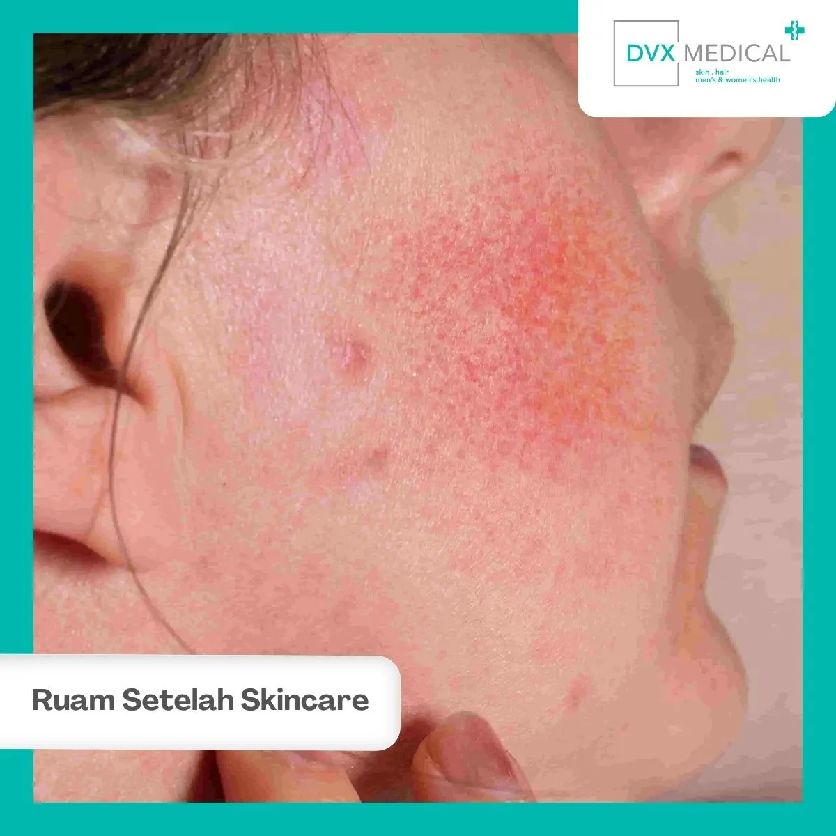 Apakah Ruam Merah Setelah Skincare Selalu Berarti Alergi?