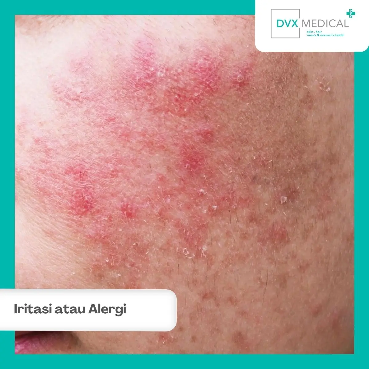 Iritasi atau Dermatitis Kontak Alergi, Apa Bedanya?
