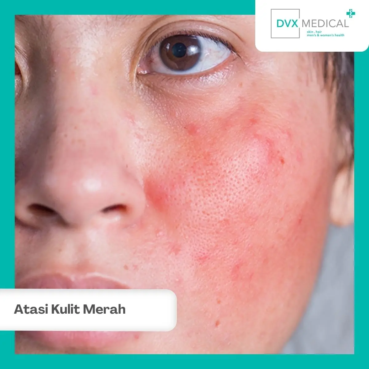 Apa yang Harus Dilakukan Saat Kulit Merah Setelah Skincare?