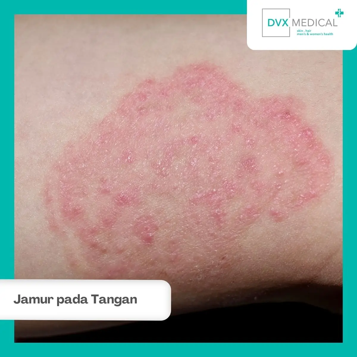 3. Infeksi Jamur pada Tangan