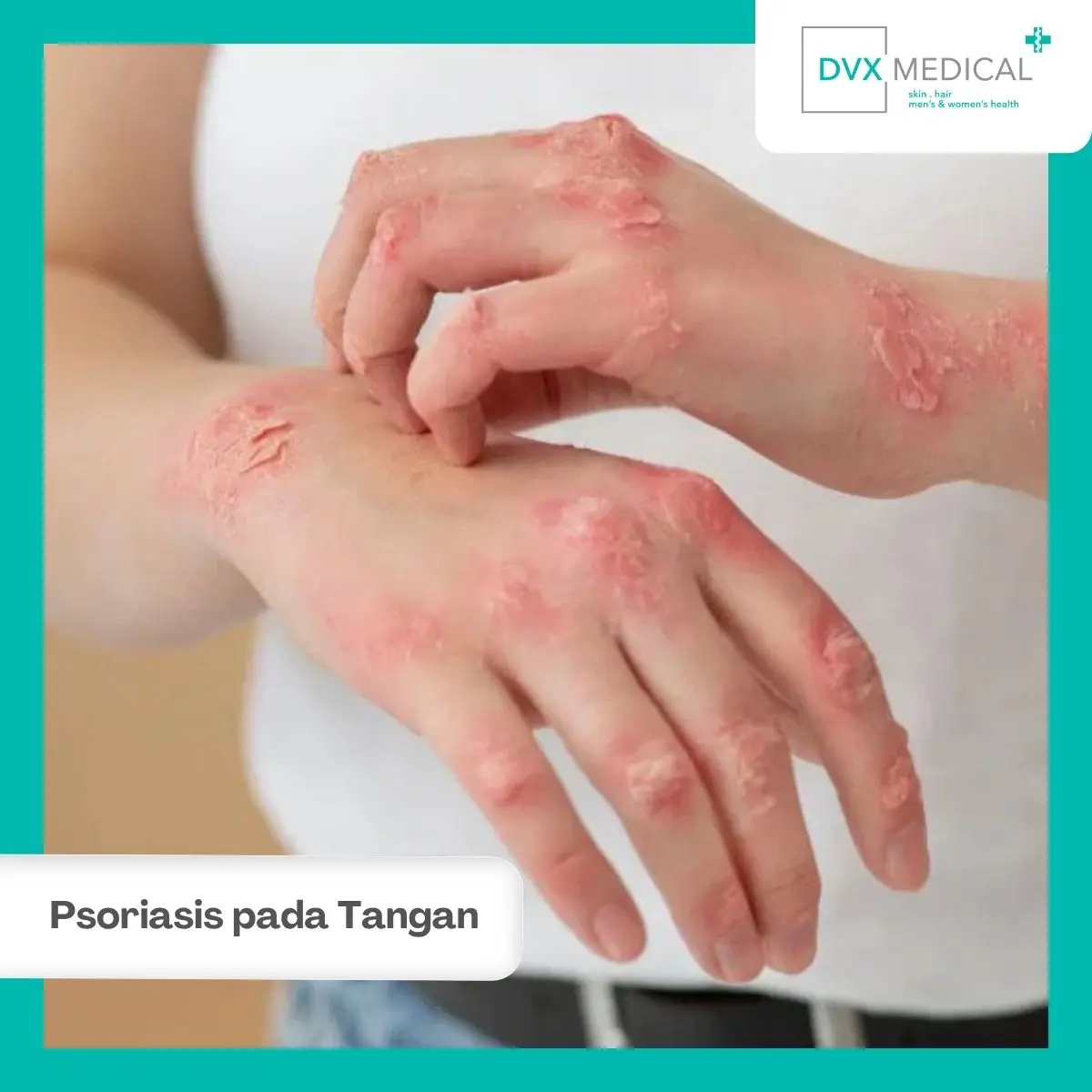 5. Psoriasis pada Tangan