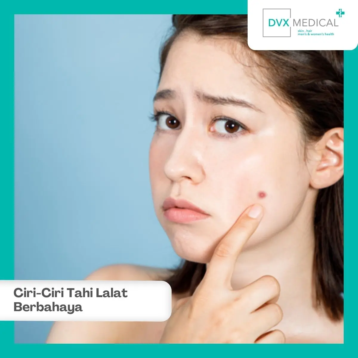 Siapa yang Berisiko Tinggi Mengalami Tahi Lalat Berbahaya?