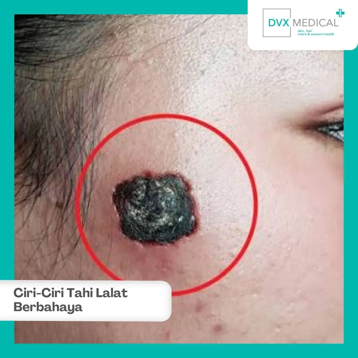 Apakah Tahi Lalat yang Membesar Selalu Berarti Kanker Kulit?