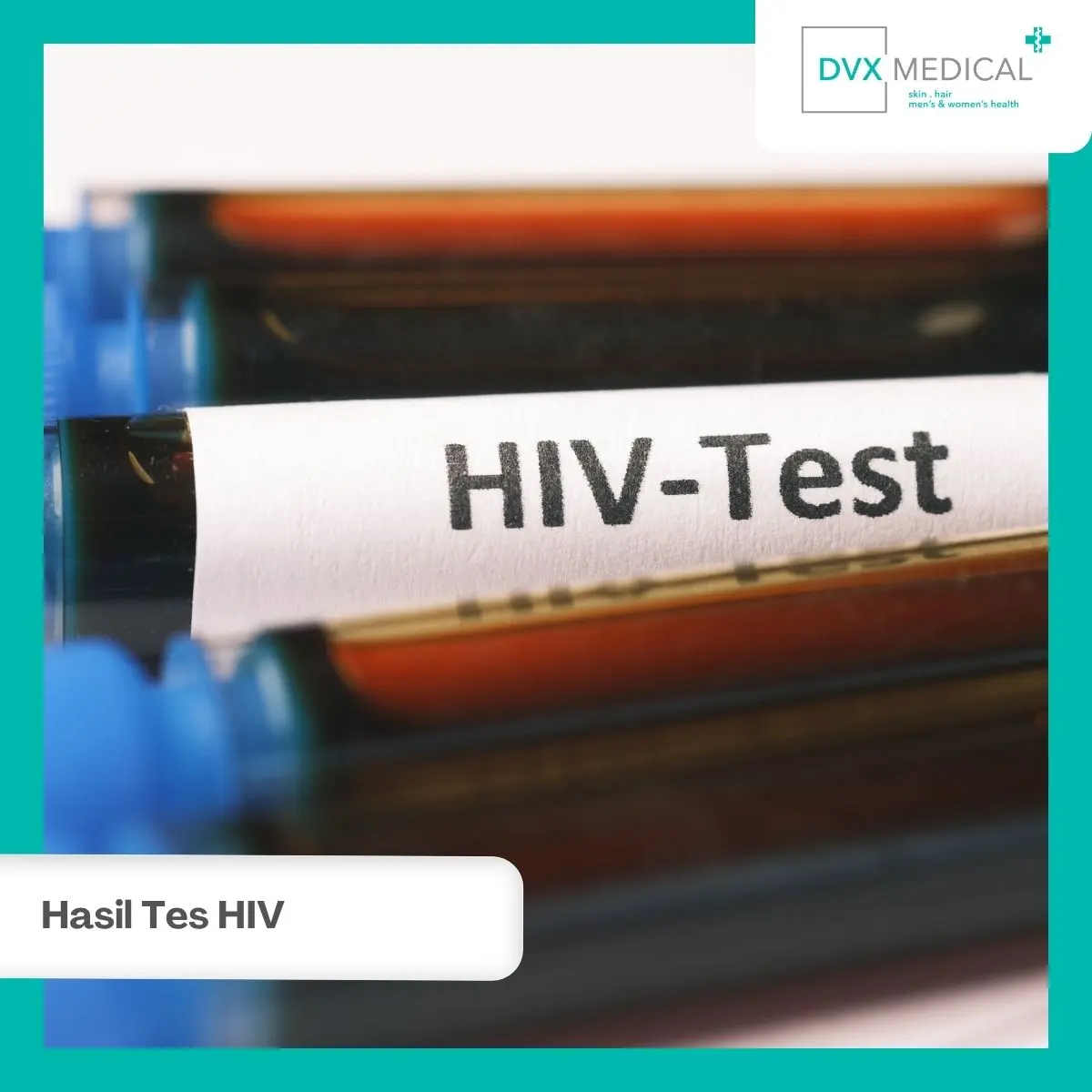 Hasil Tes HIV Sudah Keluar, Apa yang Perlu Dilihat Pertama?