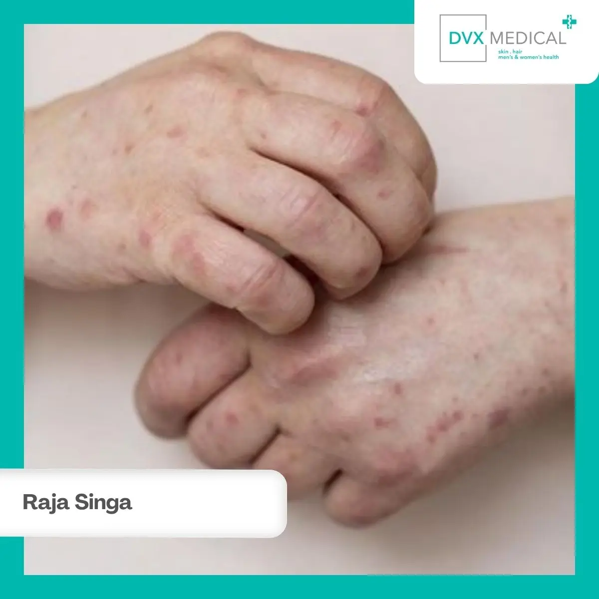 Siapa yang Berisiko Mengalami Raja Singa?