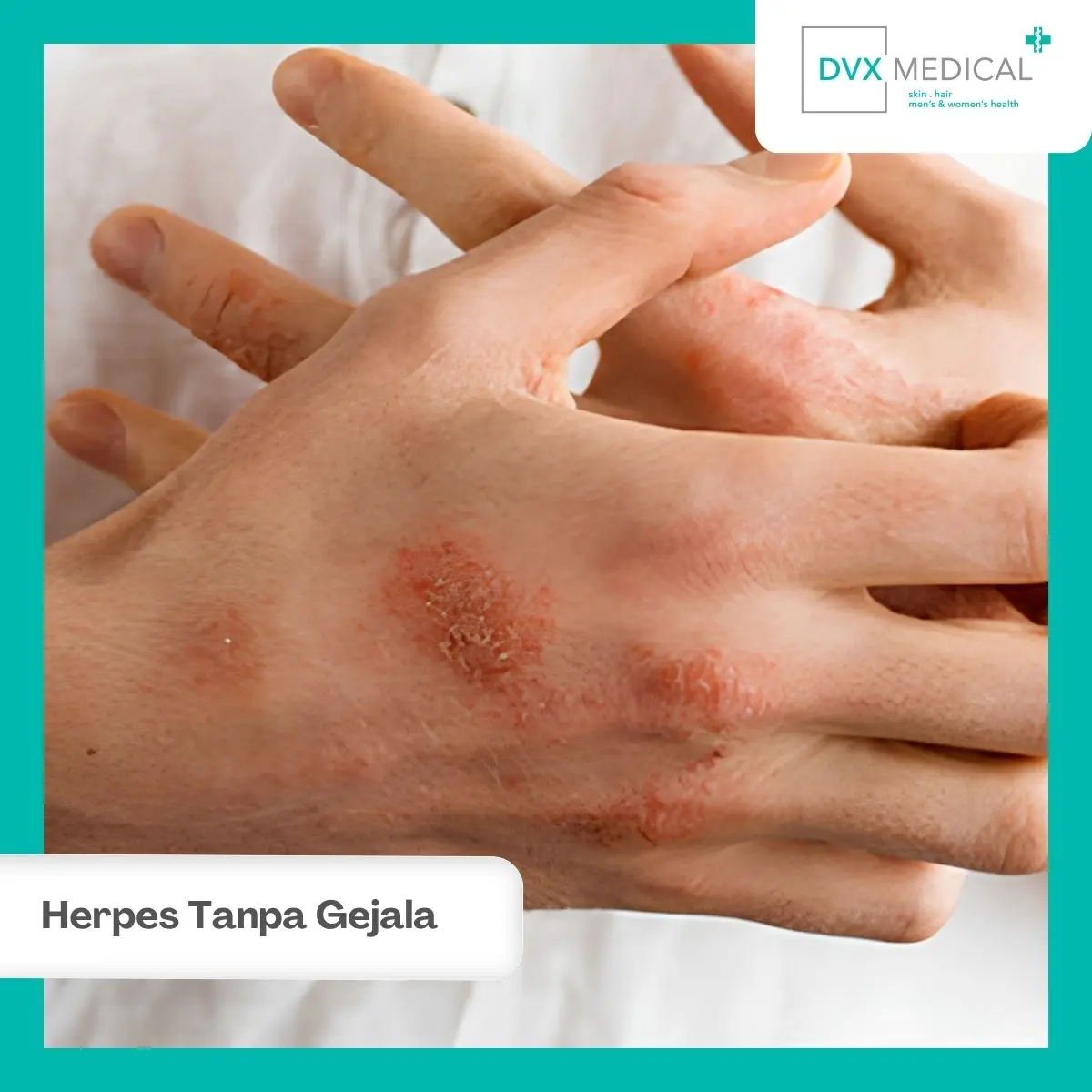 Apakah Herpes Bisa Menular Saat Tidak Ada Gejala?