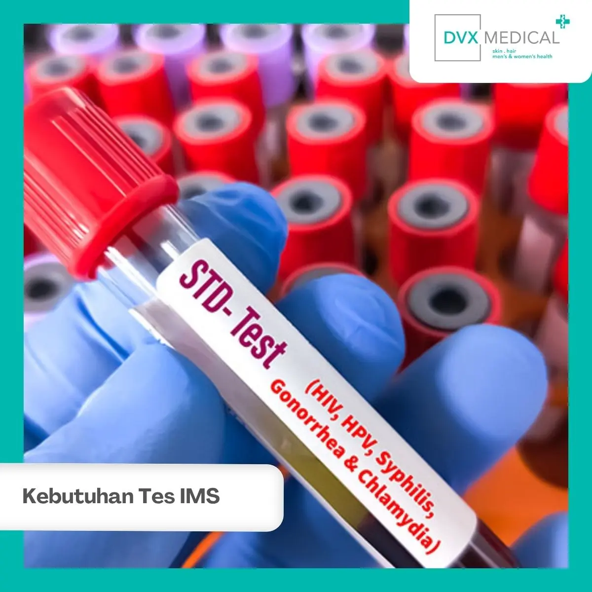 Apakah Semua Orang Membutuhkan Paket Tes IMS yang Sama?