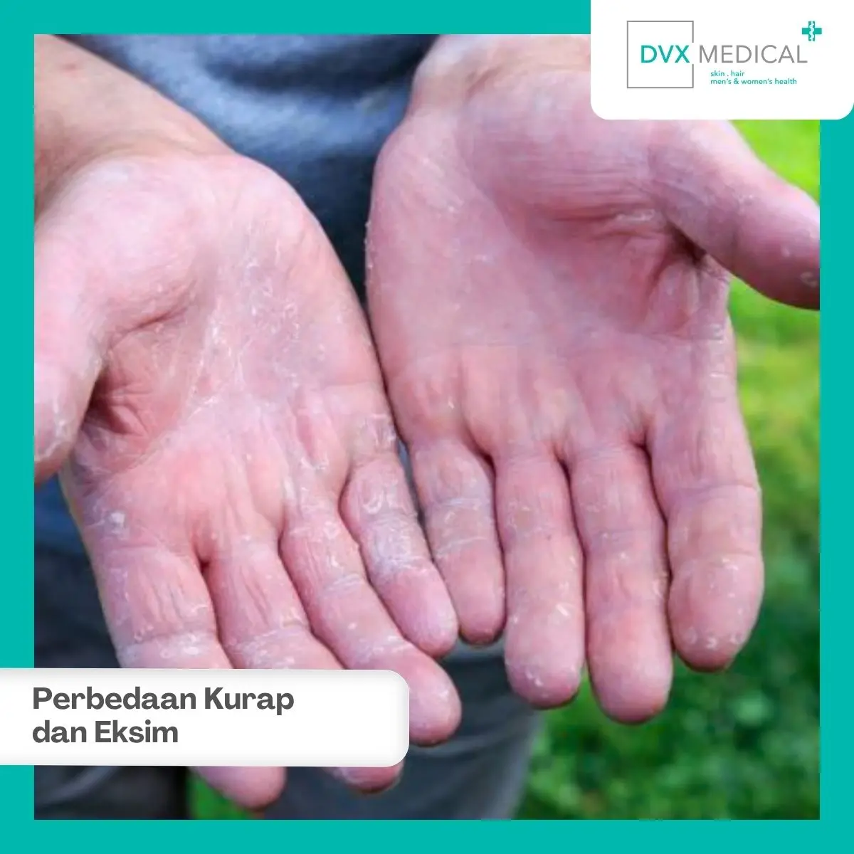 Mengapa Kurap dan Eksim Sering Terlihat Mirip?