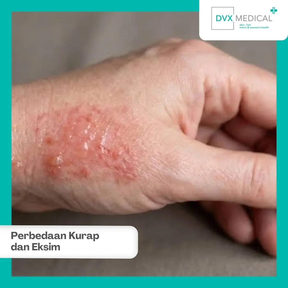 Apa Perbedaan Kurap dan Eksim? Kenali dari Ciri-Cirinya