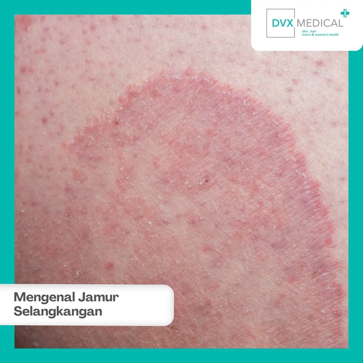 Apa Itu Jamur Selangkangan atau Tinea Cruris?