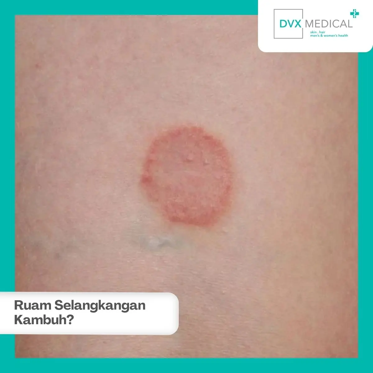 Apakah Ruam Selangkangan yang Kambuh Pasti Karena Jamur?