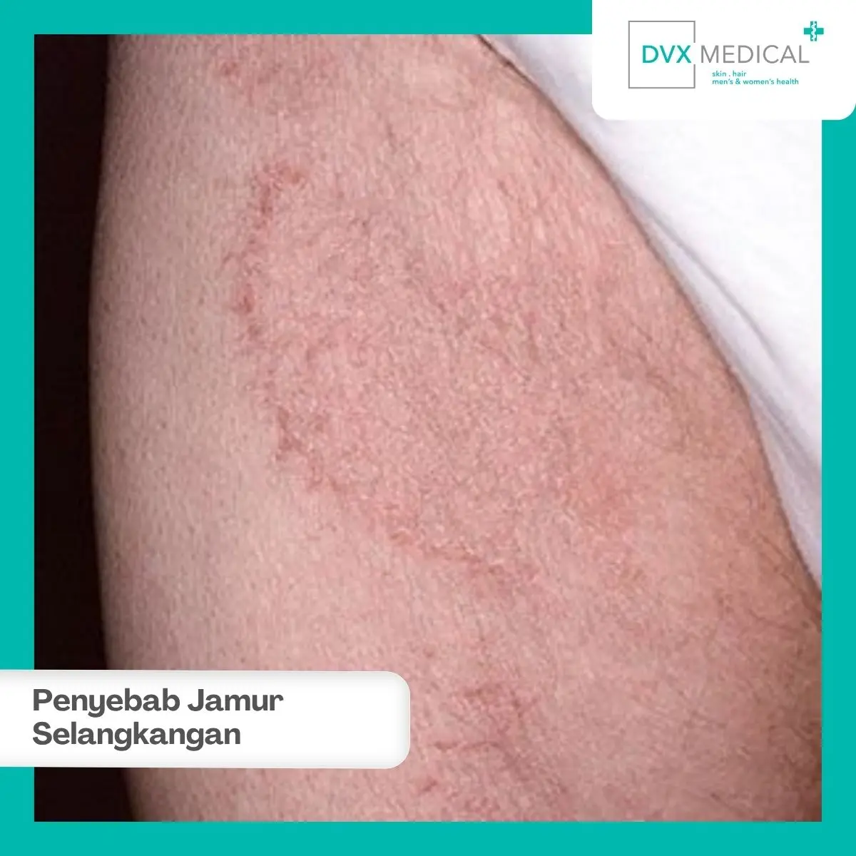 Mengapa Jamur Mudah Tumbuh di Selangkangan?