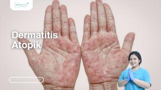 Dermatitis Atopik