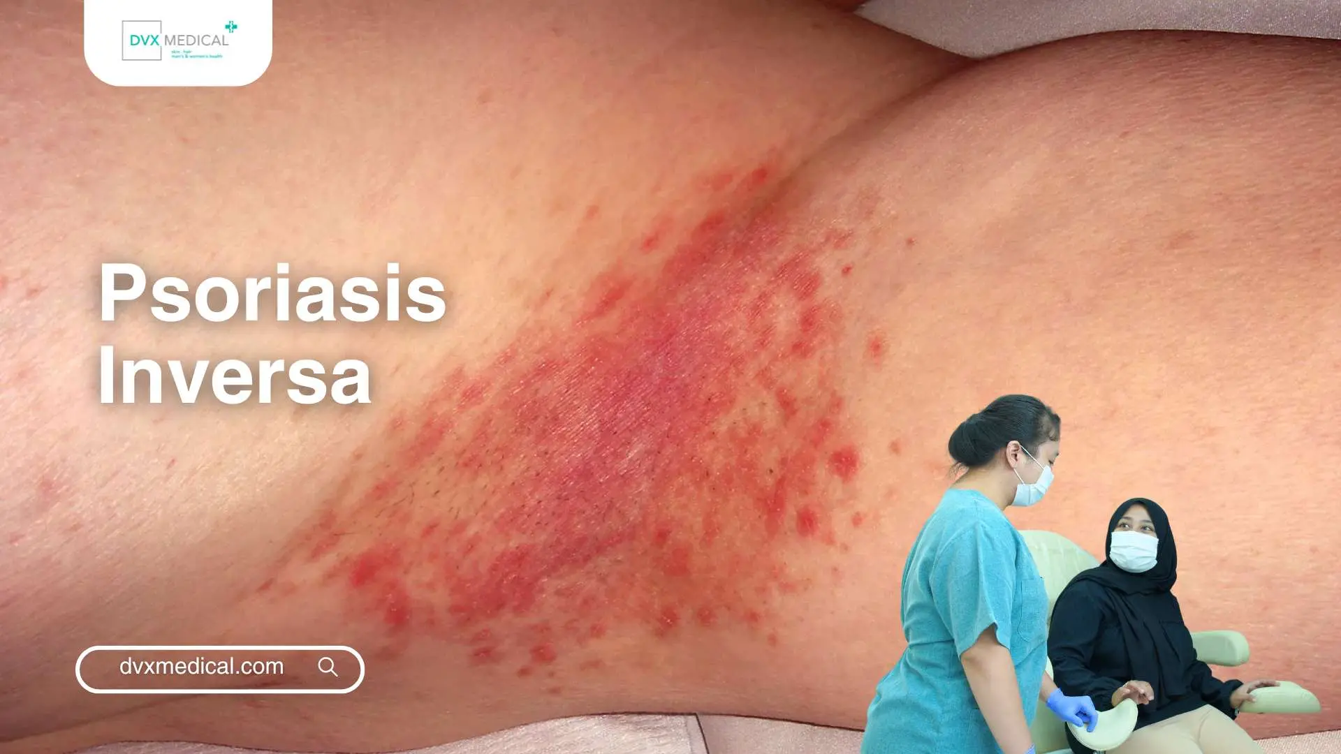 Psoriasis Inversa