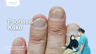 Psoriasis Kuku